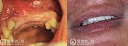 种植牙修复多颗牙缺失案例