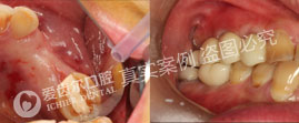 后牙缺失种植修复案例