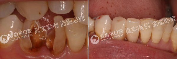 根管治疗解决蛀牙牙疼案例