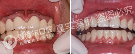 完美修复失败烤瓷牙