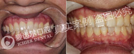 牙齿矫正——帅气脸形“矫”出来