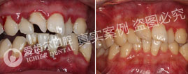 重度牙周病案例