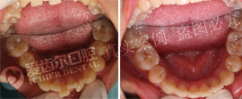 牙齿矫正摆脱饭桌异样眼光