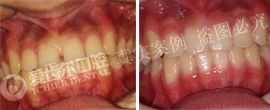 矫正告别龅牙阴影