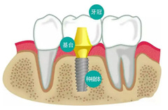 前牙种植的价格是多少？