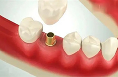 前牙缺失适合做种植牙吗？