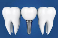 前牙种植注意事项有哪些呢？