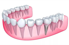 前牙种植的优势都有哪些？