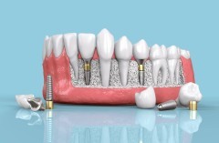 后牙缺失种植修复的优点有哪些?
