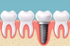 单颗牙缺失种植牙修复效果怎么样？