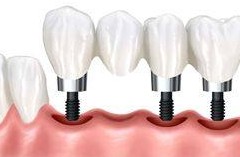 多颗种植牙护理如何做呢？