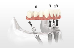半口种植牙术后如何护理？