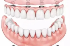 半口种植牙手术前的准备有哪些？