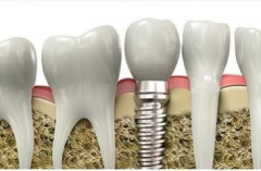 爱齿尔口腔医生详解半口种植牙全过程