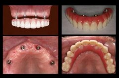 做全口种植牙修复的好处有哪些？
