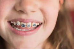 青少年矫正牙齿夏天适合吗？