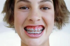 成人整牙：必须做“钢牙妹”吗？