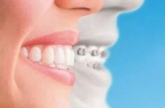 成年人牙齿矫正与儿童的区别