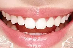 成人牙齿矫正需要拔牙吗？