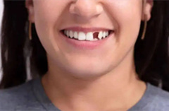 牙缺失会导致脸部变形吗？