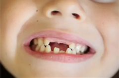 小孩乳牙缺失的危害？