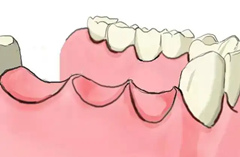 缺牙后不镶牙的隐患有哪些？