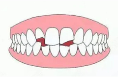 牙齿缺了一部分怎样修复？