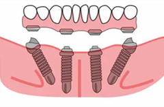 老年人全口牙缺失怎么办？