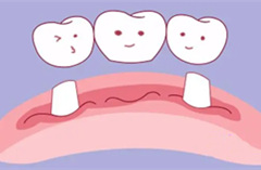 牙缺失，镶牙还是种植牙？