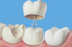 美牙冠矫正虎牙的优势有哪些？