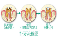 补牙三步曲，补出完整好牙！