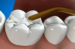 患者在补牙后为什么会出现牙疼的情况？