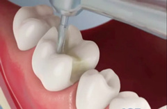 树脂补牙是怎么回事？