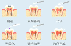 武汉补牙的步骤是怎样的？