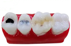 补牙时常见的填充材料有哪些？