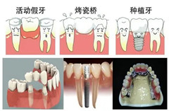 镶牙有几种？