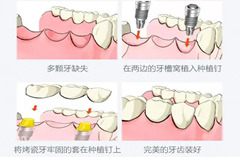 镶牙的步骤有哪些？