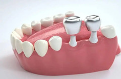 口腔固定义齿如何修复？