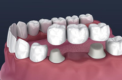 固定义齿和活动义齿有什么区别呢？