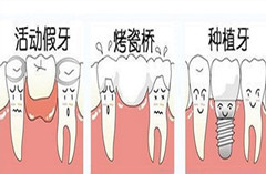 假牙有哪几种？