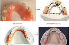 活动义齿的材料有哪些？