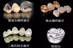 牙齿修复时，选择哪种烤瓷牙比较好？