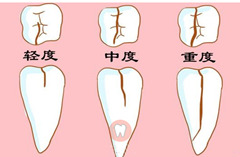 牙齿隐裂怎么修复？