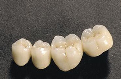 为何烤瓷牙是牙齿修复的首选方式？