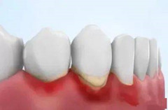 超声波洁牙，有效预防牙龈炎、牙周炎