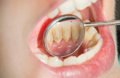 超声波洁牙能控制牙菌斑吗？