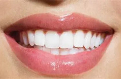 超声波洁牙可以美白牙齿吗？
