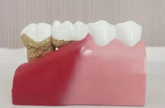 <b>喷砂洁牙能不能去除牙结石？</b>