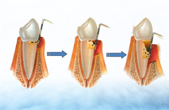 喷砂洁牙能预防牙周病吗？