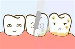 四环素牙应该怎么办？